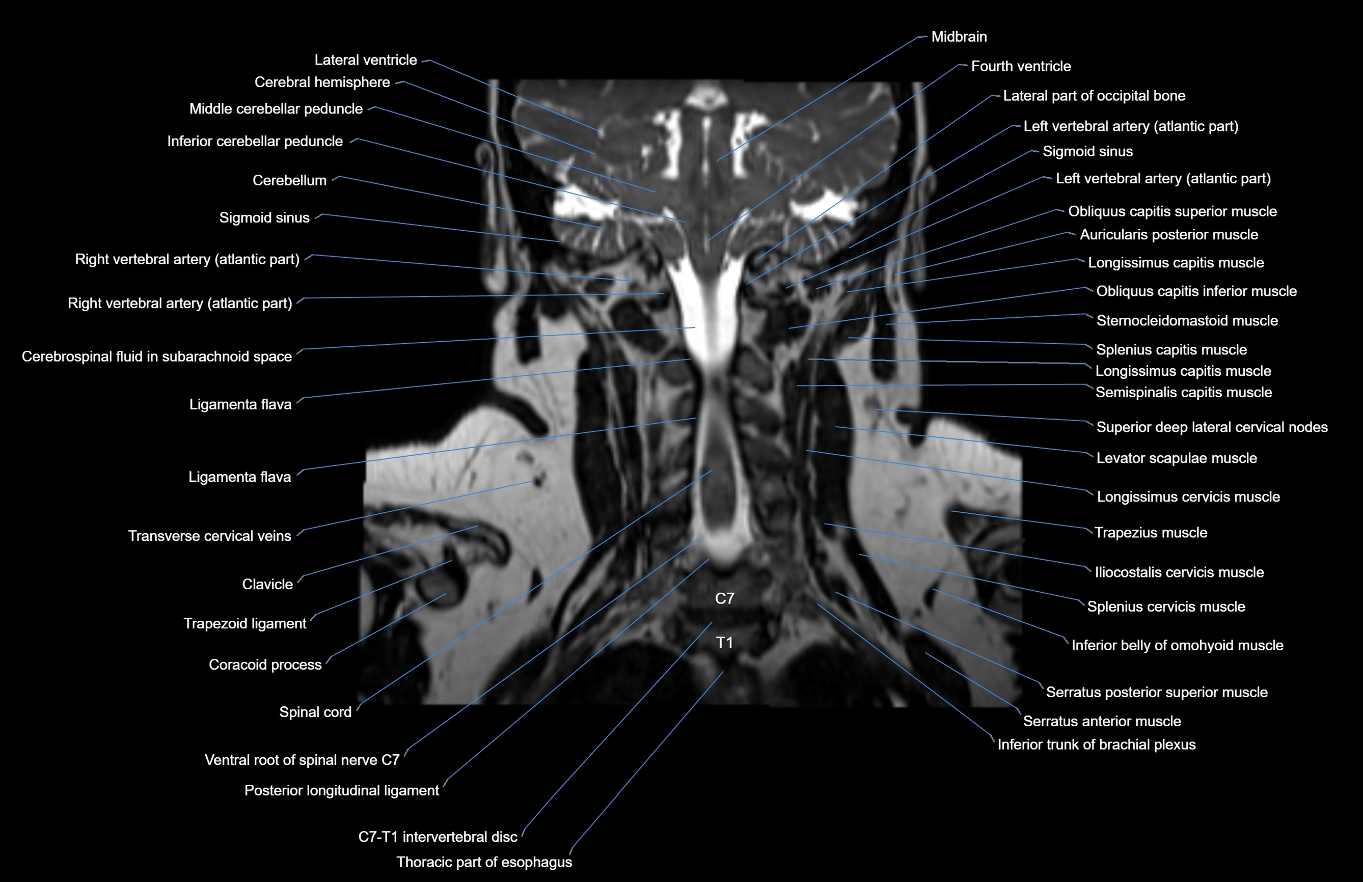 Neck coronal cross sectional MRI anatomy 3T MRI  image-img-00001-00022.webp